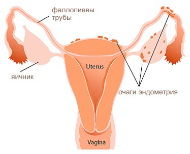 эндометриоз фото