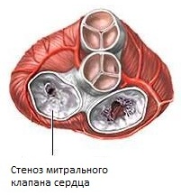 стеноз митрального клапана сердца