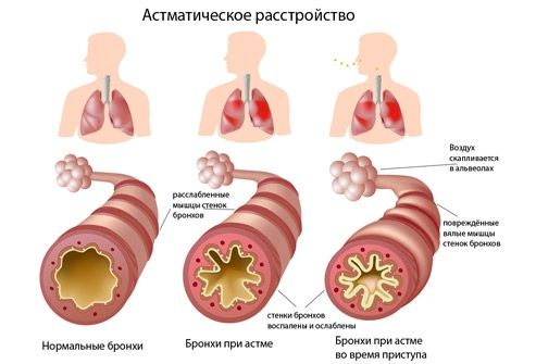 bronxialnaya-astma_4