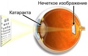 снижение остроты зрения
