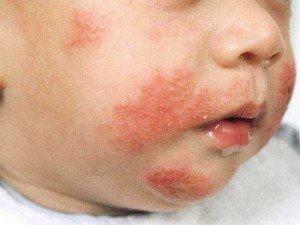 диагностика атопического дерматита у детей