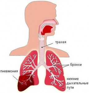 пневмония опасный недуг